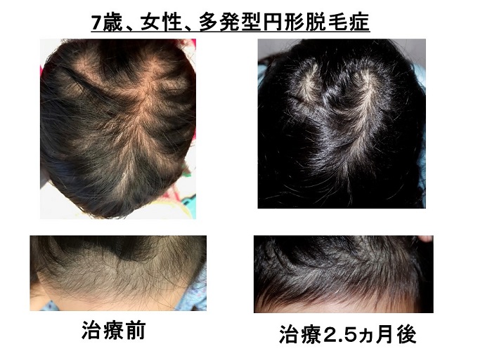 円形脱毛症　病院